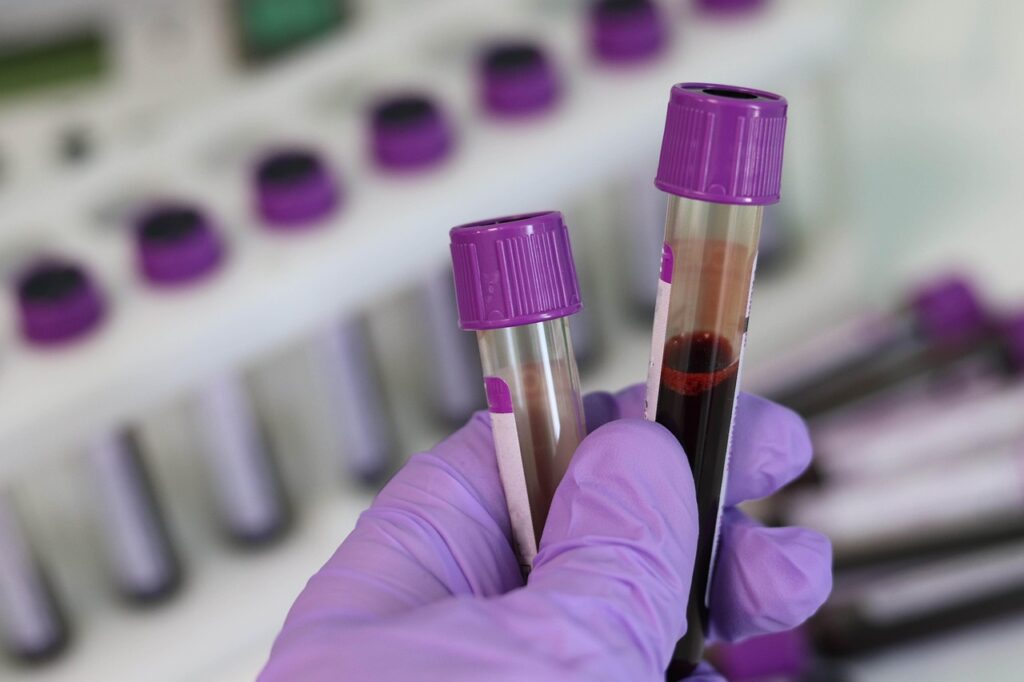 Eine Blutprobe im Reagenzglas symbolisiert die Flüssigbiopsie als Diagnoseverfahren bei Krebs – Foto: Belova59 / Pixabay